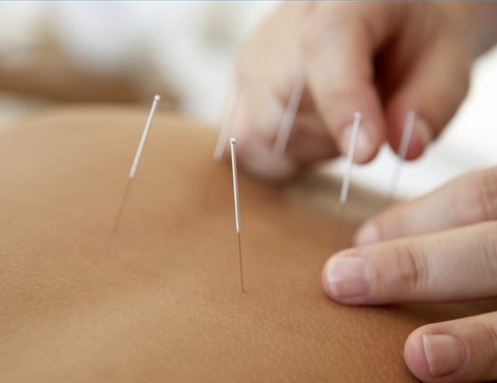 Иглорефлексотерапия - Оздоровительные услуги - Санаторий «им. Тельмана» Железноводск